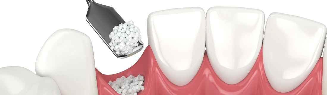 Bone Grafting in Burlington WA